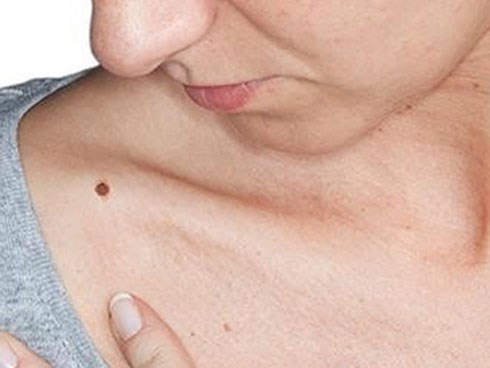 Cách nhận biết nốt ruồi nguy hiểm bạn có thể tự thực hiện