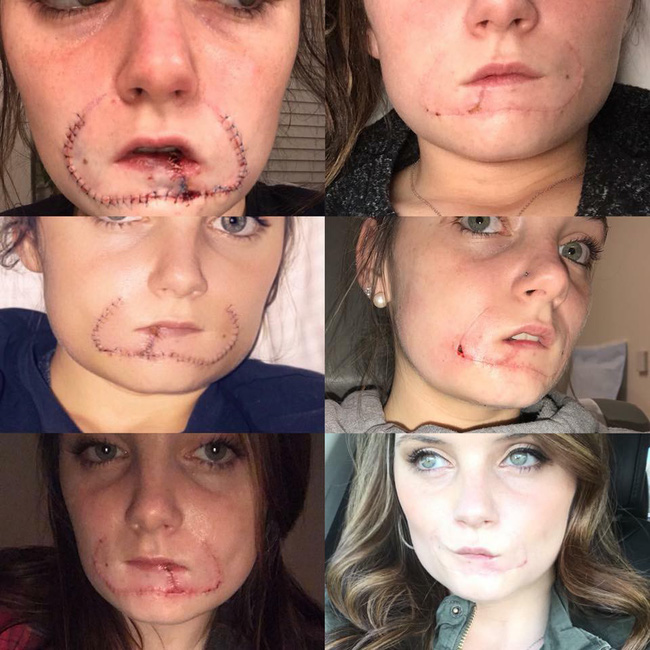 Chia sẻ nghẹn ngào của cô gái mặt biến dạng, 1 năm sau khi bị bạn trai cũ cắn đứt lìa môi vì từ chối nối lại tình xưa-3