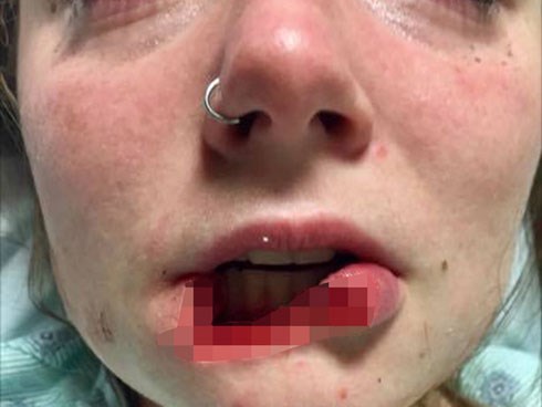 Chia sẻ nghẹn ngào của cô gái mặt biến dạng, 1 năm sau khi bị bạn trai cũ cắn đứt lìa môi vì từ chối nối lại tình xưa