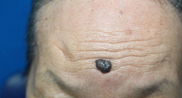 Ung thư từ nốt ruồi rất nguy hiểm, di căn nhanh: Những dấu hiệu của nốt ruồi cần cảnh giác-1