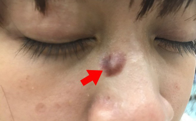 Ung thư từ nốt ruồi rất nguy hiểm, di căn nhanh: Những dấu hiệu của nốt ruồi cần cảnh giác-2