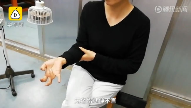 Giật mình với hình ảnh bàn tay bị liệt và cột sống cong: Bài học cho những ai hay dùng điện thoại theo cách này-1