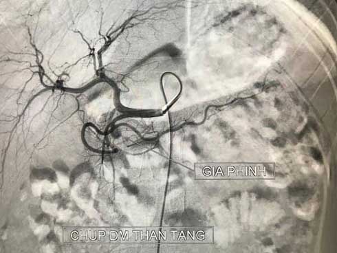 Bé 11 tuổi nôn ra máu ồ ạt không cầm được: Chú ý khi con đau ở phần bụng trên-1
