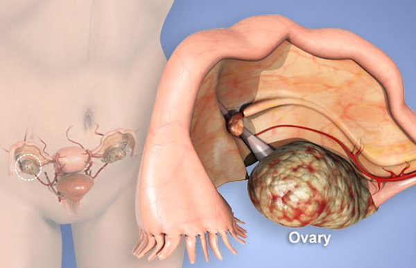 Bác sĩ cảnh báo căn bệnh ung thư khiến Miss Teen qua đời ở tuổi 25-2