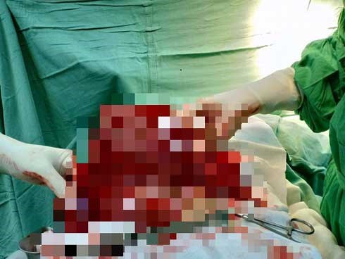 Nghĩ do ngồi nhiều nên bụng to, nào ngờ khối u nặng 4kg đang hành hạ