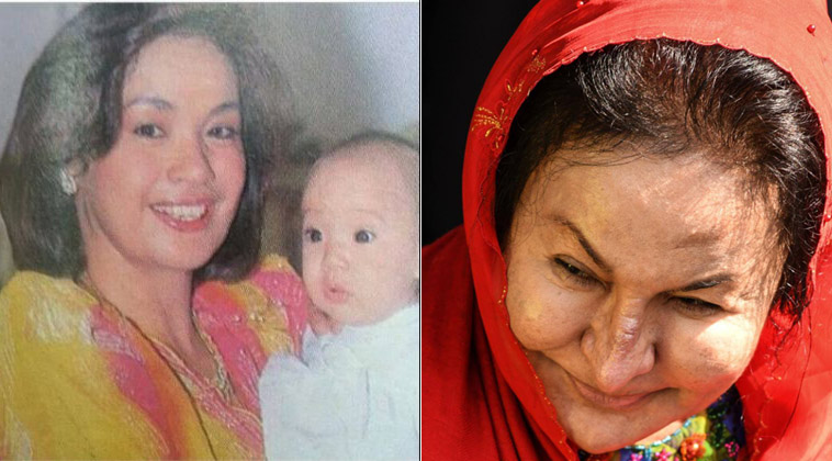 Gương mặt phu nhân cựu Thủ tướng Malaysia biến dạng  vì thẩm mỹ-1