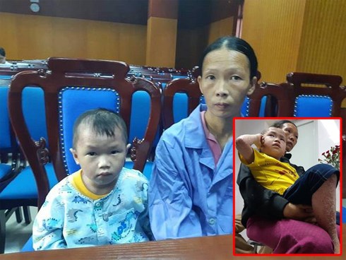 Bé trai 5 tuổi sống trong thân hình “người cóc” vì sai lầm của mẹ hiện giờ ra sao?