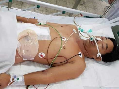 Người đàn ông sống sót thần kỳ sau 27 ngày điều trị vì bị cưa máy cắt ngang bụng kinh hoàng