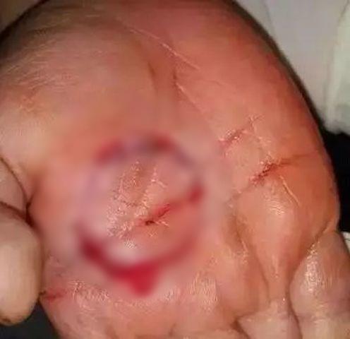 Cô gái bị đứt gân tay vì phần nguy hiểm trên cây lau nhà không phải ai cũng để ý-2