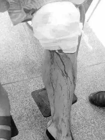 Cô gái bị đứt gân tay vì phần nguy hiểm trên cây lau nhà không phải ai cũng để ý-3