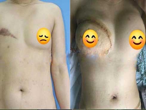 Người phụ nữ nhiều năm phải nhét giẻ vào ngực vì lý do đau đớn-1