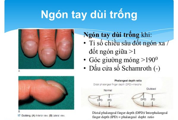 Những dấu hiệu ở móng tay cảnh báo bạn mắc bệnh nặng, có cả ung thư-2