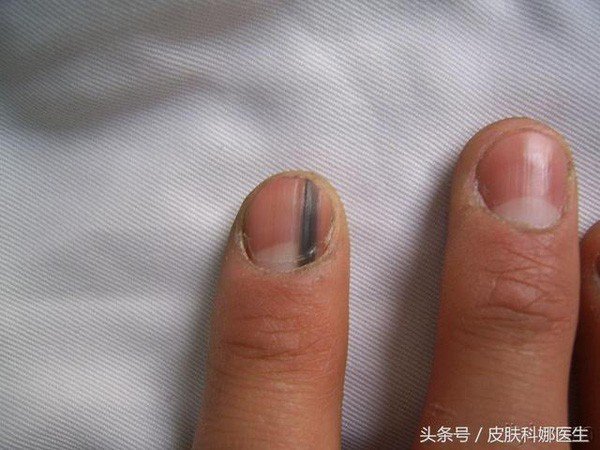 Những dấu hiệu ở móng tay cảnh báo bạn mắc bệnh nặng, có cả ung thư-3