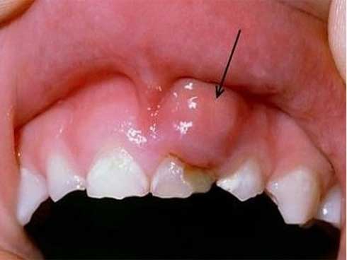 Dấu hiệu ở miệng cảnh báo ung thư: Ai đau trên 1 tháng phải đi khám ngay, đừng để muộn-1