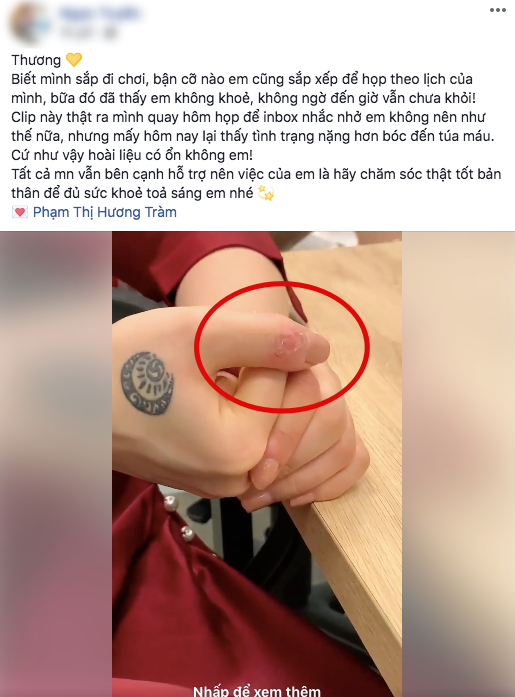 Hương Tràm liên tục mất ngủ, stress đến mức tự bóc tay rỉ máu khiến người hâm mộ lo lắng-2