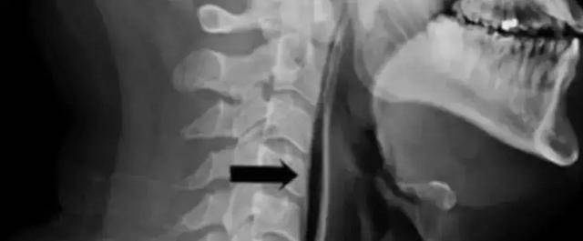 Người đàn ông 34 tuổi nhịn hắt hơi dẫn đến vỡ… cổ họng-1