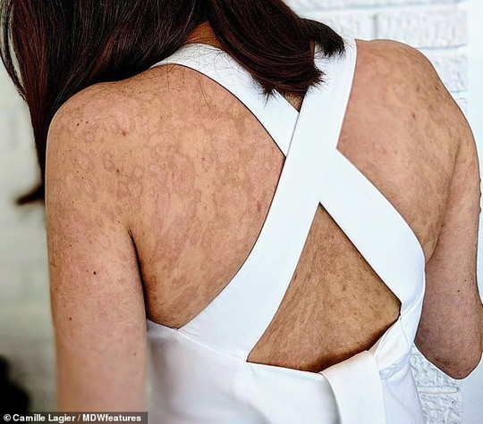 Chỉ vài viên kháng sinh, cô gái xinh đẹp hóa xác ướp-5