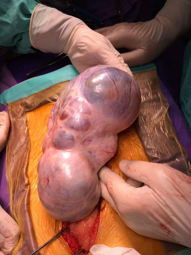 Cắt khối u dài 20cm như bào thai em bé cho bệnh nhân ung thư buồng trứng-1