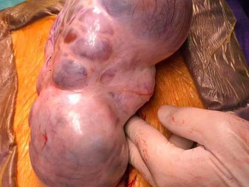 Cắt khối u dài 20cm như