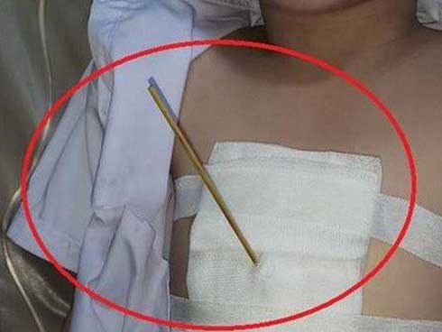 Bé 7 tuổi bị bạn dùng cây xiên cá viên chiên đâm trúng ngực
