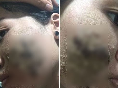 Góc cảnh báo: Cứ thích lăn kim, lột da nữa đi, bạn sẽ 'mất mặt' như chơi đó!