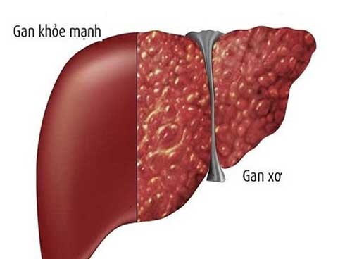Gia đình 3 thế hệ mắc ung thư gan và lời cảnh báo