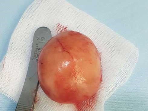 Người đàn ông 48 năm chung sống cùng ...3 tinh hoàn