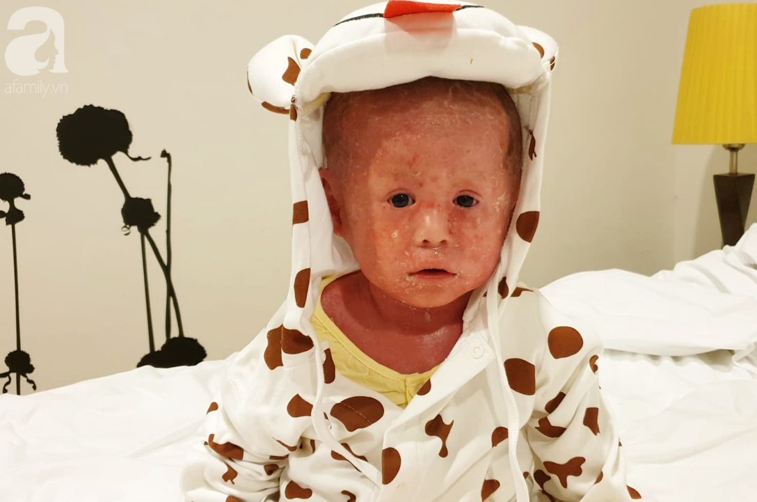 Hình ảnh mới nhất của bé Bích bị bỏ rơi, người đầy vẩy ngứa như da trăn sau đợt khám bệnh đầu tiên tại Singapore-2