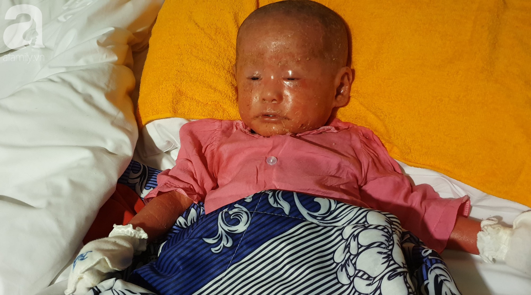 Hình ảnh mới nhất của bé Bích bị bỏ rơi, người đầy vẩy ngứa như da trăn sau đợt khám bệnh đầu tiên tại Singapore-3