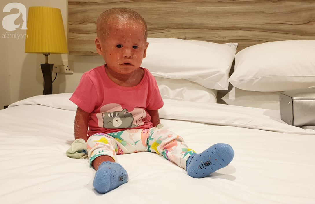 Hình ảnh mới nhất của bé Bích bị bỏ rơi, người đầy vẩy ngứa như da trăn sau đợt khám bệnh đầu tiên tại Singapore-4