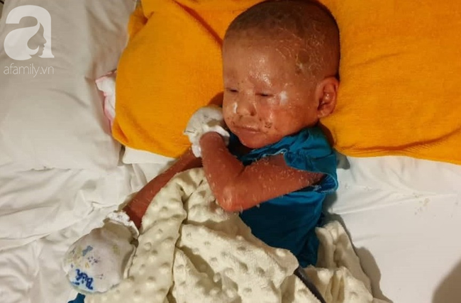 Hình ảnh mới nhất của bé Bích bị bỏ rơi, người đầy vẩy ngứa như da trăn sau đợt khám bệnh đầu tiên tại Singapore-5