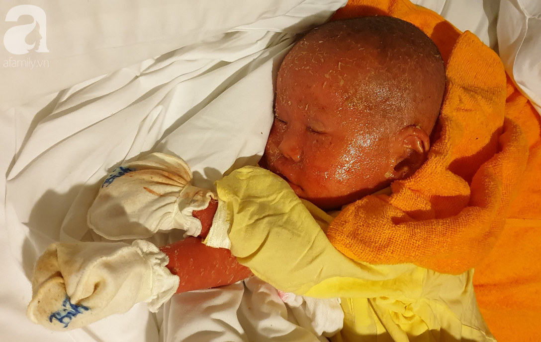 Hình ảnh mới nhất của bé Bích bị bỏ rơi, người đầy vẩy ngứa như da trăn sau đợt khám bệnh đầu tiên tại Singapore-6