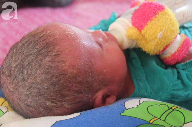 Hình ảnh mới nhất của bé Bích bị bỏ rơi, người đầy vẩy ngứa như da trăn sau đợt khám bệnh đầu tiên tại Singapore-11
