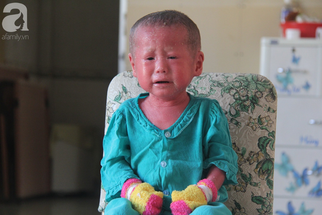Hình ảnh mới nhất của bé Bích bị bỏ rơi, người đầy vẩy ngứa như da trăn sau đợt khám bệnh đầu tiên tại Singapore-12