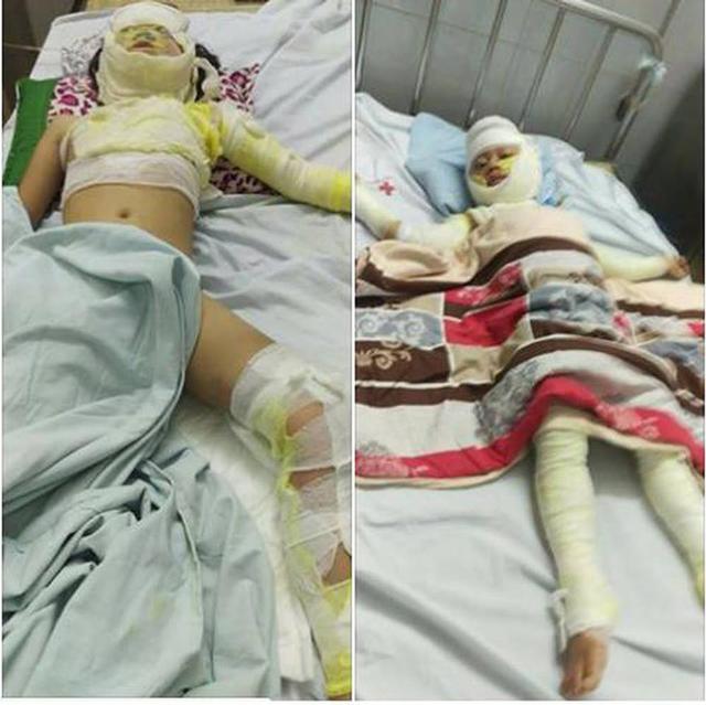 Bố nướng mực bằng cồn, con 2 tuổi tử vong, 3 người nguy kịch-1