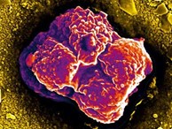 Vì sao tế bào ung thư sinh sôi và di căn nhanh bất thường?