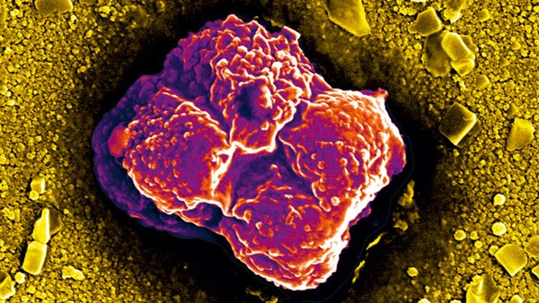 Vì sao tế bào ung thư sinh sôi và di căn nhanh bất thường?-1