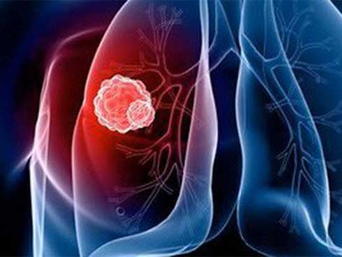 Người đàn ông bị nhức vai, đi khám sốc vì ung thư phổi giai đoạn cuối-4