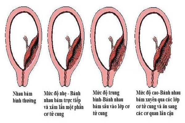 Từng phá thai 6 lần, đến lần thứ 7 mẹ trẻ sinh con nhưng gia đình không ai dám bế-5