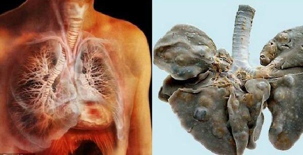 Sán lúc nhúc trong phổi thanh niên 19 tuổi vì món ăn nhiều người Việt thích-2