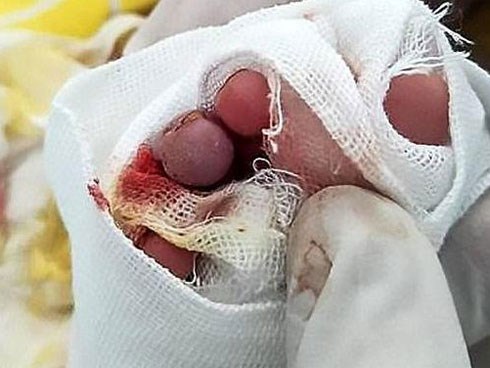 Chàng trai trẻ bị sốt 4,5 ngày không khám, tới viện khiến bác sĩ giật mình khi cởi giày ra