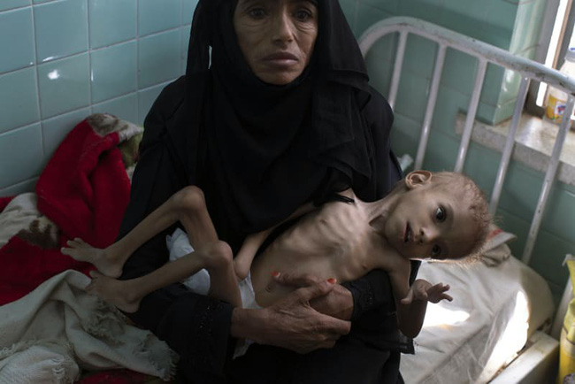 Bé gái trong bức ảnh gây chấn động thế giới về nạn đói đã qua đời, trở thành biểu tượng đau đớn của cuộc khủng hoảng tại Yemen-2