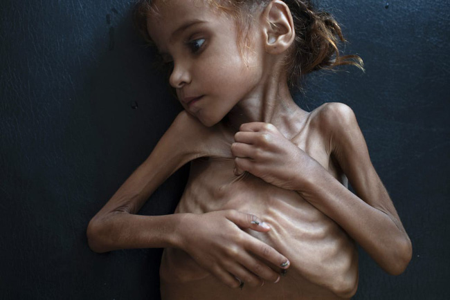 Bé gái trong bức ảnh gây chấn động thế giới về nạn đói đã qua đời, trở thành biểu tượng đau đớn của cuộc khủng hoảng tại Yemen-1