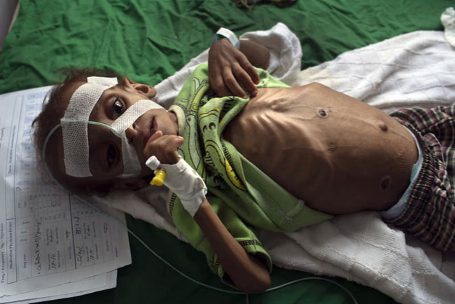 Bé gái trong bức ảnh gây chấn động thế giới về nạn đói đã qua đời, trở thành biểu tượng đau đớn của cuộc khủng hoảng tại Yemen-3