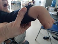 Sau cơn sốt nhẹ, mẹ bàng hoàng phát hiện cánh tay con trai 1 tuổi bị liệt hoàn toàn