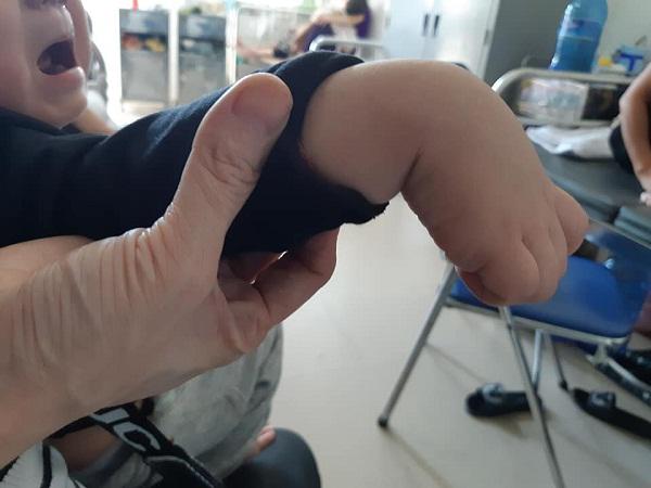 Sau cơn sốt nhẹ, mẹ bàng hoàng phát hiện cánh tay con trai 1 tuổi bị liệt hoàn toàn-2