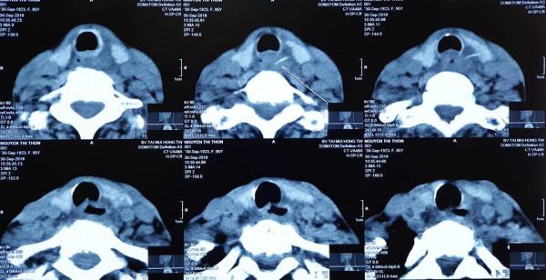 Nữ bệnh nhân bị xương cá đâm xuyên cổ, BS cảnh báo: Tuyệt đối không làm điều này khi ăn-5