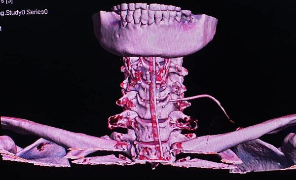 Nữ bệnh nhân bị xương cá đâm xuyên cổ, BS cảnh báo: Tuyệt đối không làm điều này khi ăn-2