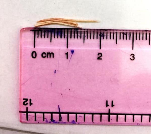 Nữ bệnh nhân bị xương cá đâm xuyên cổ, BS cảnh báo: Tuyệt đối không làm điều này khi ăn-4