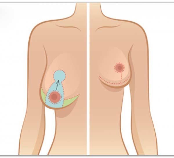 Ngực quả mướp” và những lầm tưởng của hầu hết mọi người-1